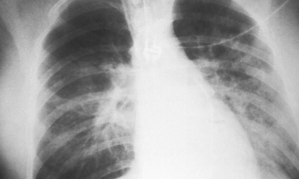 How does air affect health