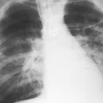 How does air affect health