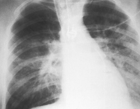 How does air affect health